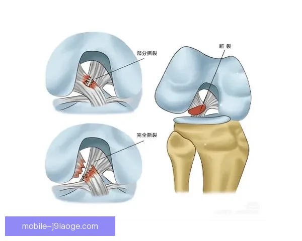 罗德里十字韧带断裂的诊断与治疗策略分析及康复路径探讨 罗德里十字韧带断裂的诊断与治疗策略分析及康复路径探讨